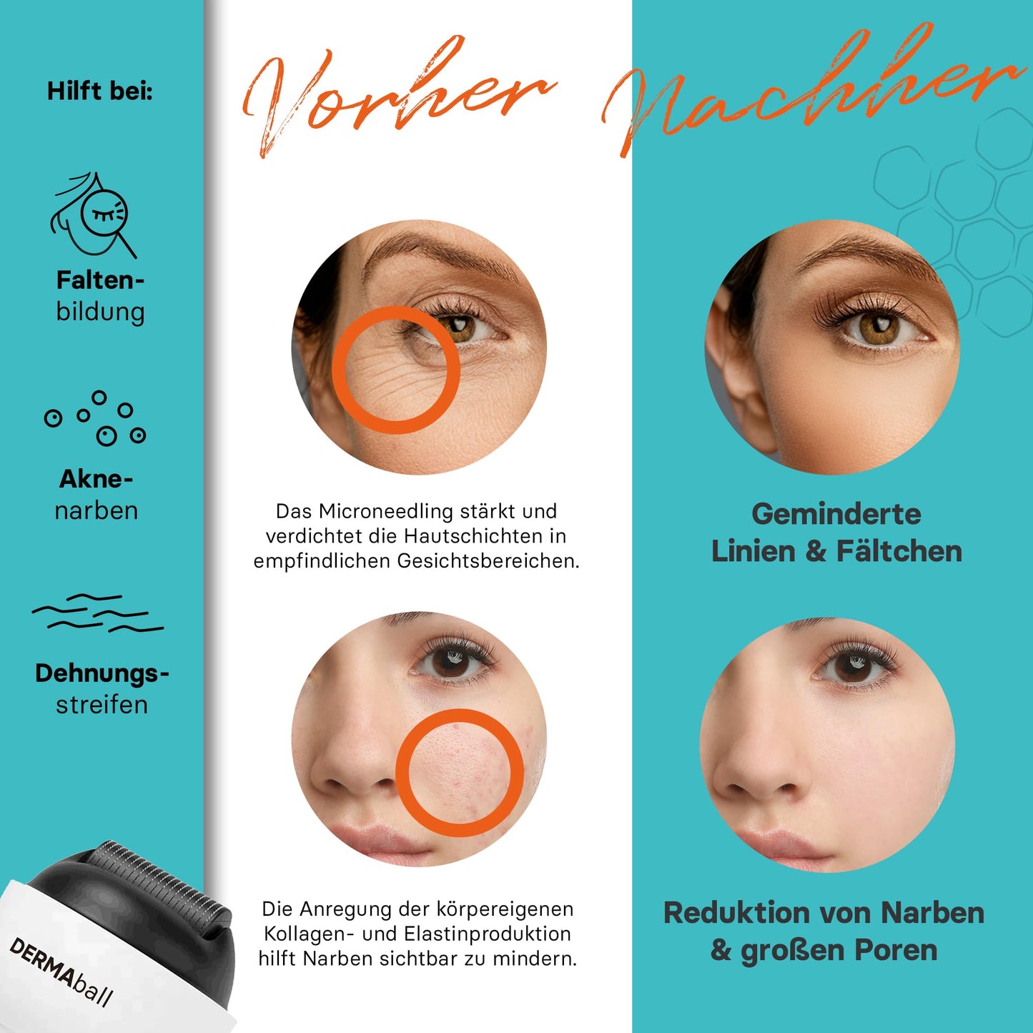 BS Luxry® Testsieger Dermaball– Professionelles Microneedling für Zuhause Hairroller mit 1200 Edelstahl-Mikronadeln – Bartroller für Bartwuchs, Haarwachstum & Gesicht – 0,5mm Needling