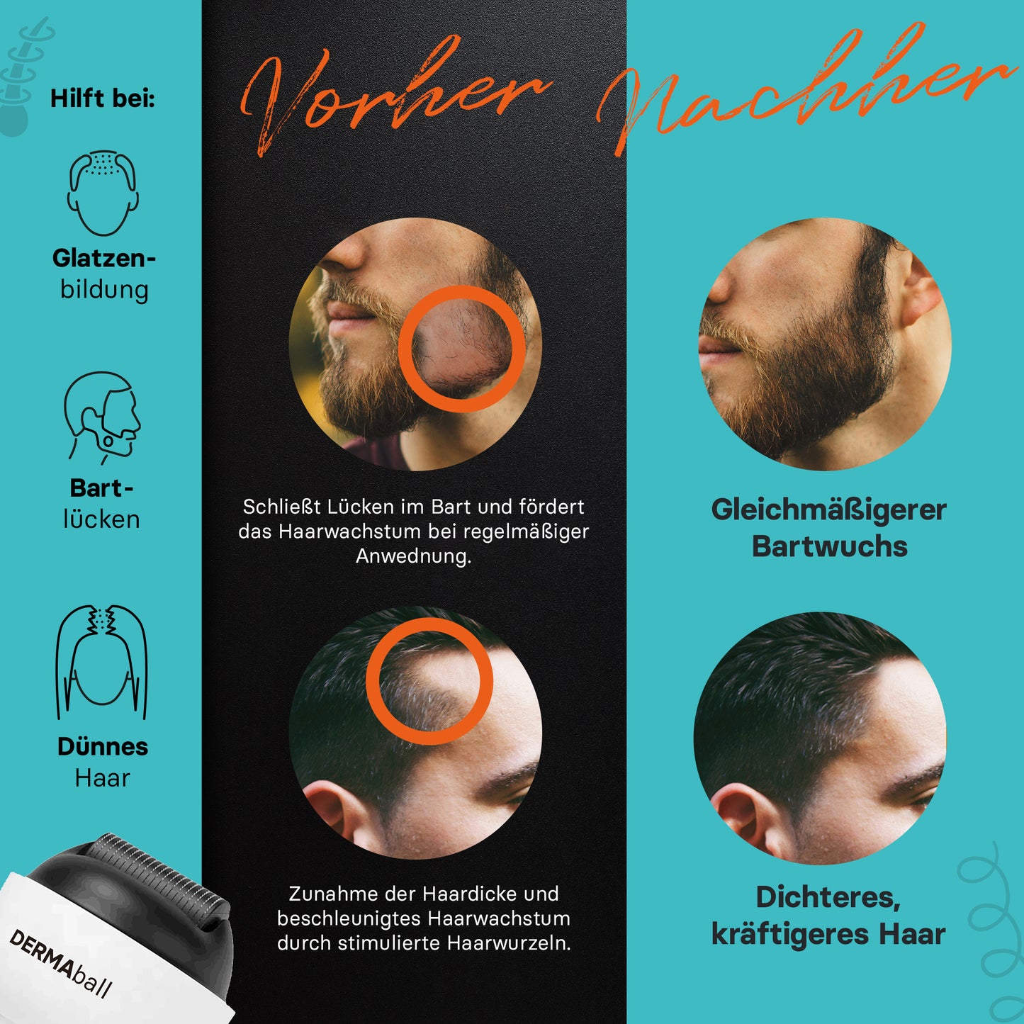 BS Luxry® Testsieger Dermaball– Professionelles Microneedling für Zuhause Hairroller mit 1200 Edelstahl-Mikronadeln – Bartroller für Bartwuchs, Haarwachstum & Gesicht – 0,5mm Needling